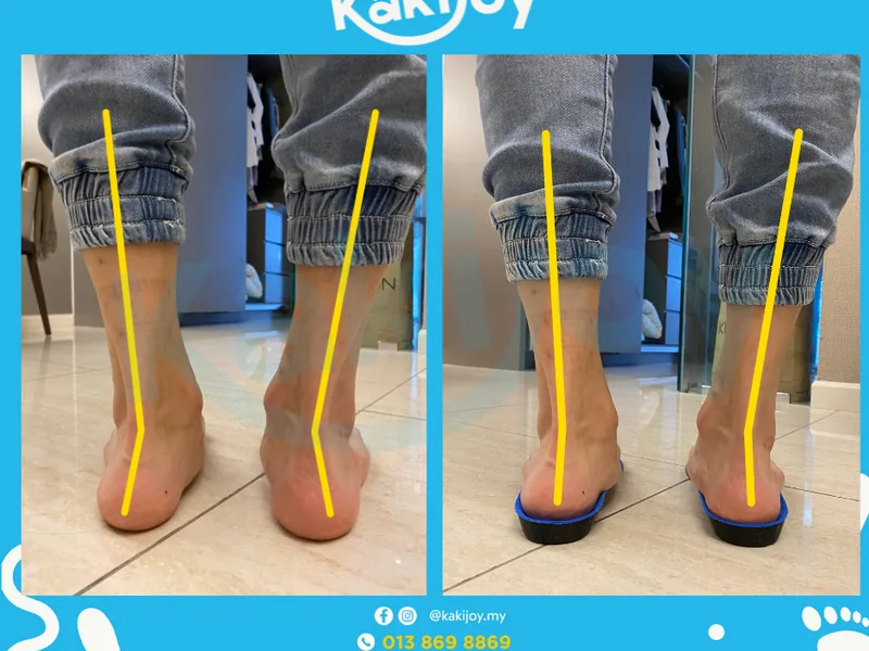 Side-by-side comparison of an adult foot before and after arch support