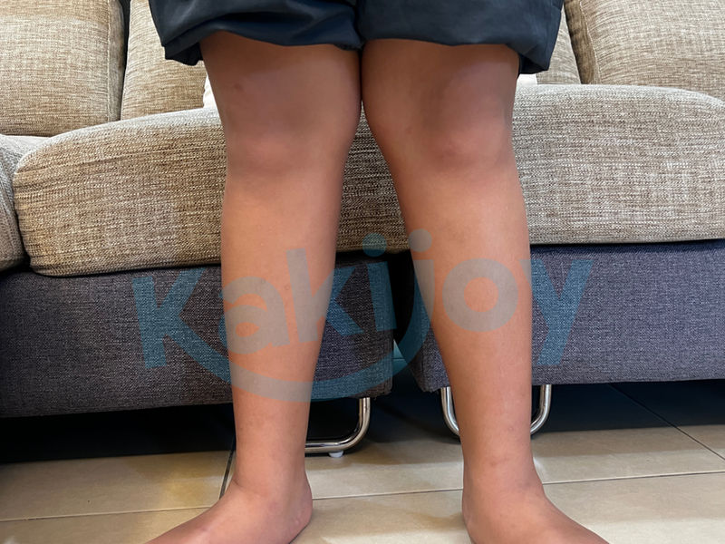 A child's lower legs standing, showing mild outward-pointing feet
