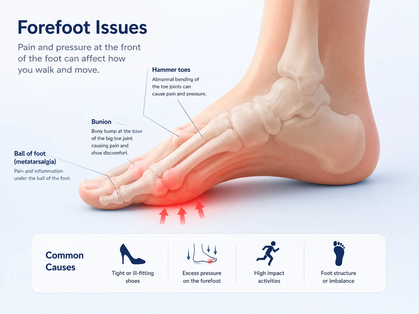 Labeled forefoot diagram showing bunion at the base of the big toe, hammer toes, and ball-of-foot (metatarsalgia) pain points, with four common causes: tight or ill-fitting shoes, excess pressure on the forefoot, high impact activities, and foot structure imbalance