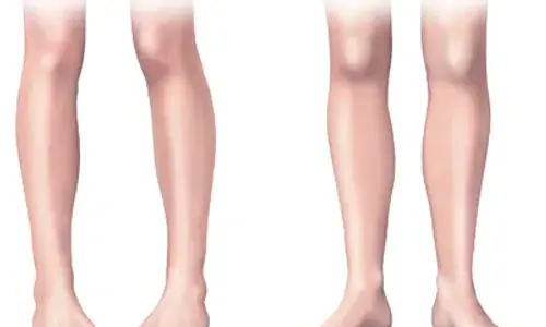 In-toeing & Out-toeing — deep dive — illustration